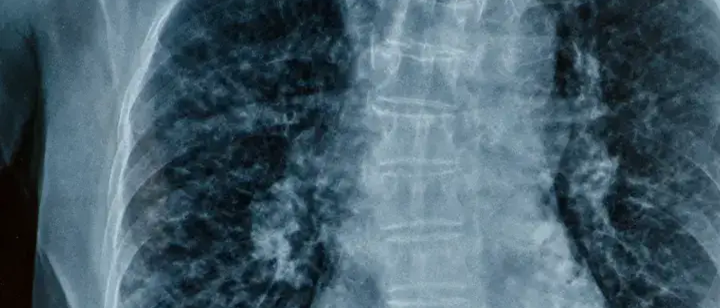 Mesothelioma: Understanding the Disease and Your Legal Rights